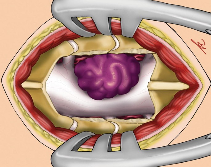 An illustration depicts the representational drawing of the surgical field. The retractor is holding the skin to perform surgery.