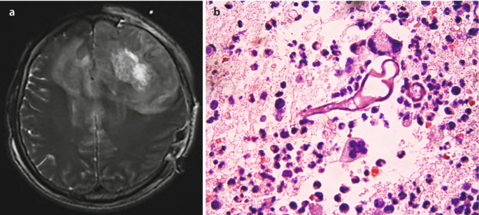 An M R image of the brain. Dense patches are present around the brain, indicating the presence of infection. The corresponding histological slide has darkly-stained structures that represent the pathogenic organisms.