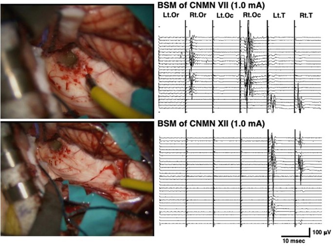 Two intraoperative views of the removal of the tumor and hematoma. On the right are two C B T-M E P recordings for B S M of C N M N seven and twelve.