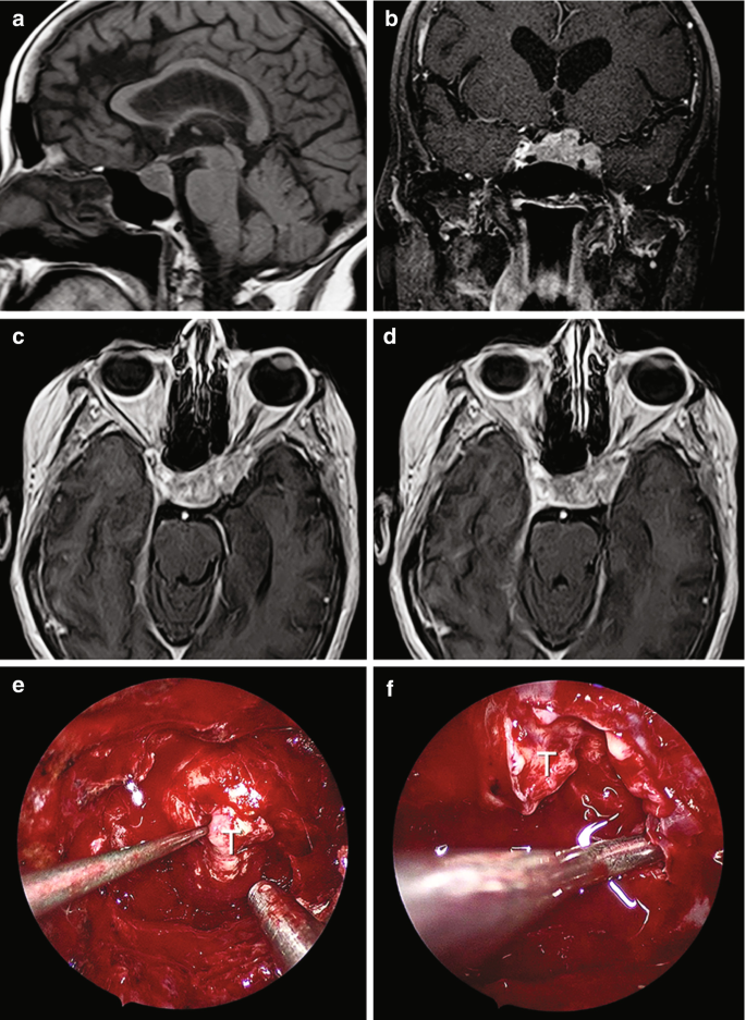 A sagittal, a coronal, and 2 axial M R I scans of the brain with tumor cells in the pituitary gland and 2 endoscopic intraoperative views of the pituitary glands with tumor cells.