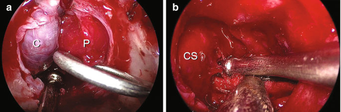 Two endoscopic views of the lesions in the pituitary gland with cell masses labeled C and P in the first and C S in the second.