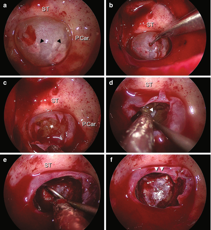 6 endoscopic intraoperative views of the clival chordoma with B N C T highlight the following. A. S T, paraclival carotids, and cortical clival bone. B. S T. C. S T, paraclival carotids, and tumor. D. S T and posterior fossa dura. E. S T. F. Sphenoid sinus mucosa.