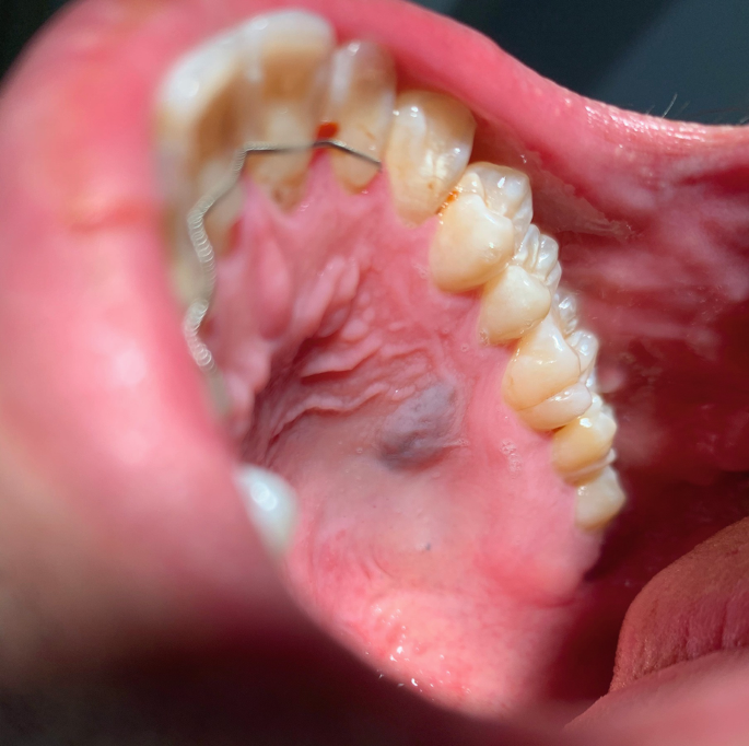 melanotic macule roof of mouth Melanotic Macules, Naevi, and Melanoma