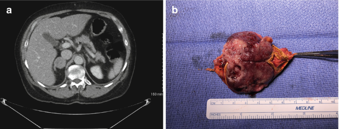 A C T scan image and a photograph. a. Pheochromocytoma in the right adrenal gland. b. Resected specimen with a horizontal ruler labeled Medline.