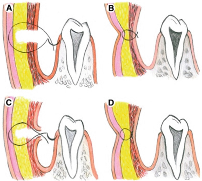 Dimple Creation Surgery | Springer Nature Link (formerly SpringerLink)