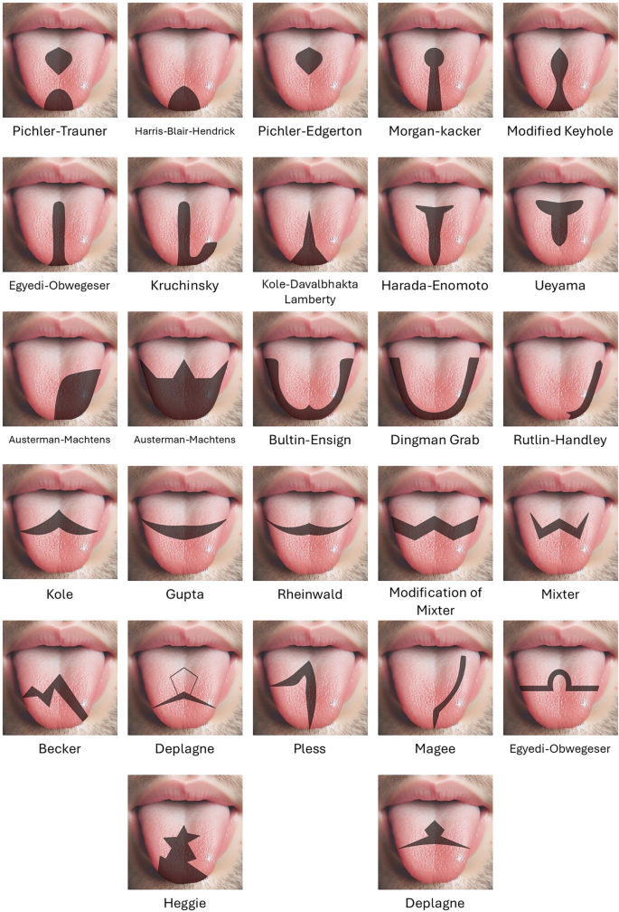 Base of Tongue Surgery | Springer Nature Link