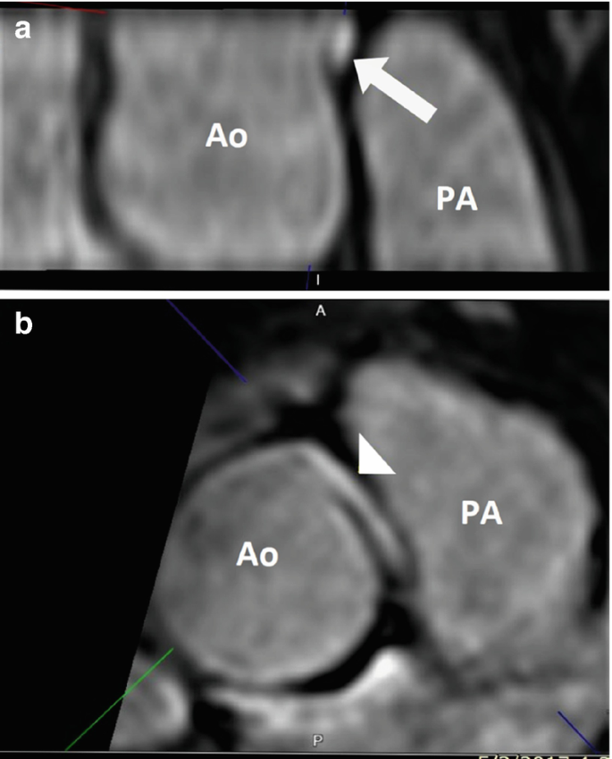 2 radiographs A and B of the aorta, featuring the size and shape difference of the pulmonary artery. A has more details and B has colored lines to measure the distance.