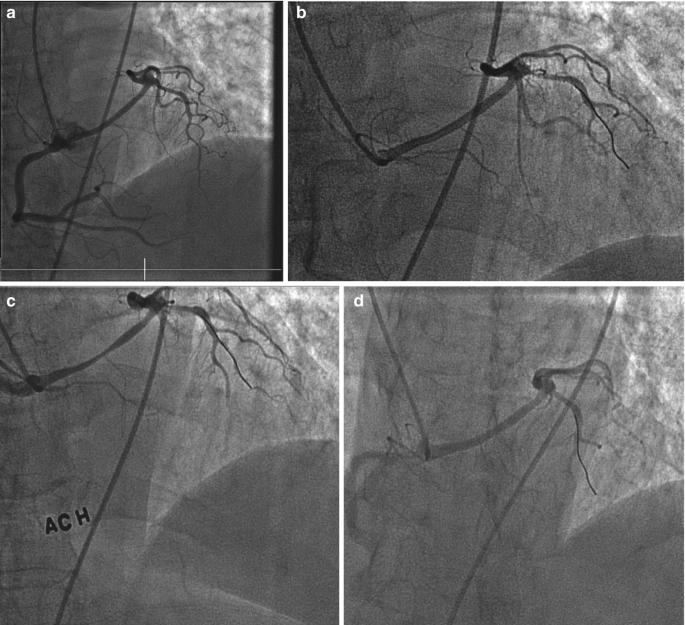 A set of 4 angiograms, A to D, of brain blood vessels explain how they react to different treatments. They feature a normal vessel, a tight vessel, a squeezed vessel, and a relaxed vessel.