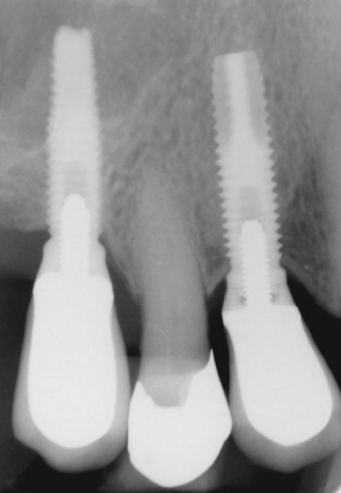 A sagittal radiograph represents 2 complete implants and a crown implant between them. The left implant is less-structured compared to the right implant.