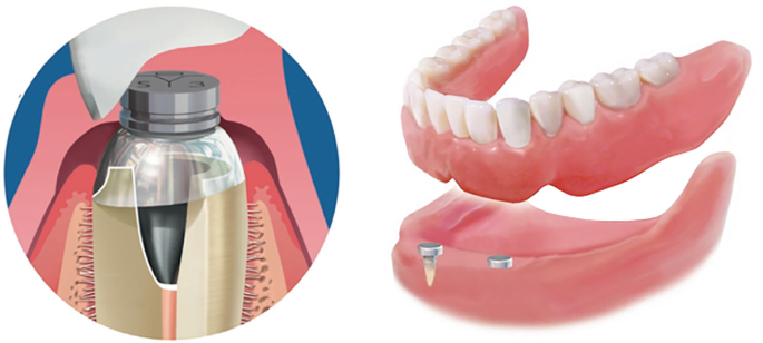 Magnetic Attachment Used in Tooth-Supported Overdentures
