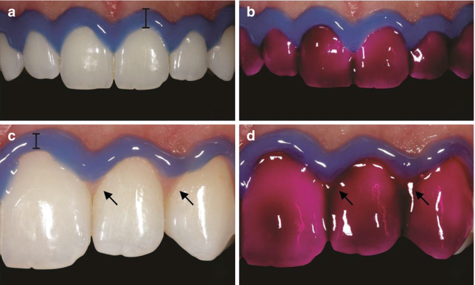 4 photos. a and b. A frontal view of the upper teeth line. The gingival tissue is covered with a rubber dam and the teeth are applied with bleaching gel. c and d. The gingival tissue of the upper teeth line is covered by a rubber dam with the soft tissues, and the teeth are applied by bleaching gel.