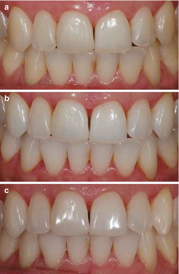 3 photos of the upper and lower teeth line. a. Teeth line before restoration, with a visible gingival margin. b. Teeth line after applied with a brightening agent and a visible gingival margin. c. Teeth line after restoration.