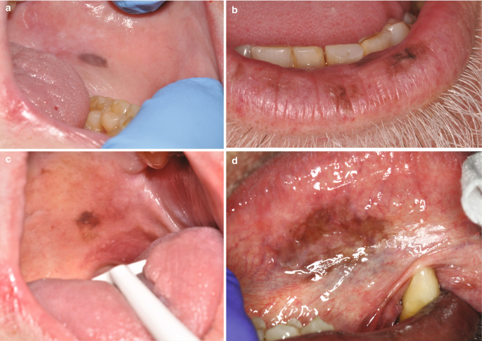 oral melanotic macule treatment at home Oral Melanotic Macule oral melanotic macule treatment at home Oral Melanotic Macule