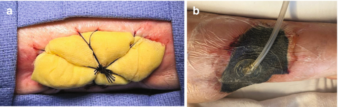 Surgical Site Dressing | Springer Nature Link