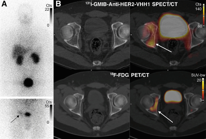 6 P E T images of the whole body and that of a single vertebra. The presence of tumors is identified as dark-shaded regions with an illuminated surface after antibody administration.