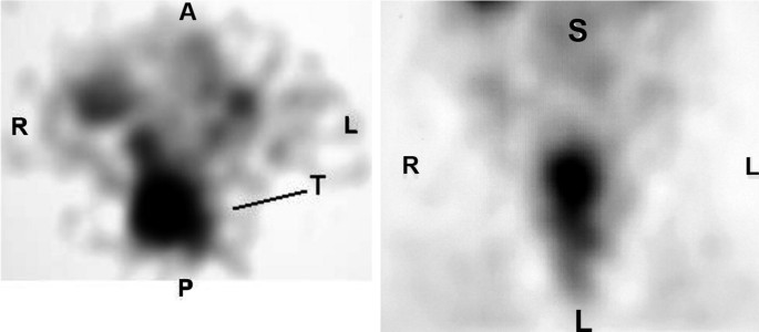 2 S P E C T images of rectal tumor with different antibody labels. The left and right images are marked A, L, P, R and S, L, L, R, in the 15-minute marks clockwise direction, respectively. The dark region is labeled T in the left image. The size of the dark region is reduced in the right image.