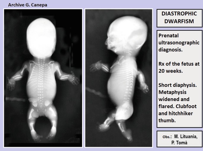 A set of 2 ultrasonograms of a 20-week-old fetus. The left scan is a frontal scan of the body, and the right scan is a lateral view. The ultrasonographs represent short diaphysis, metaphysics widened and flared, clubfoot, and hitchhiker's thumb.