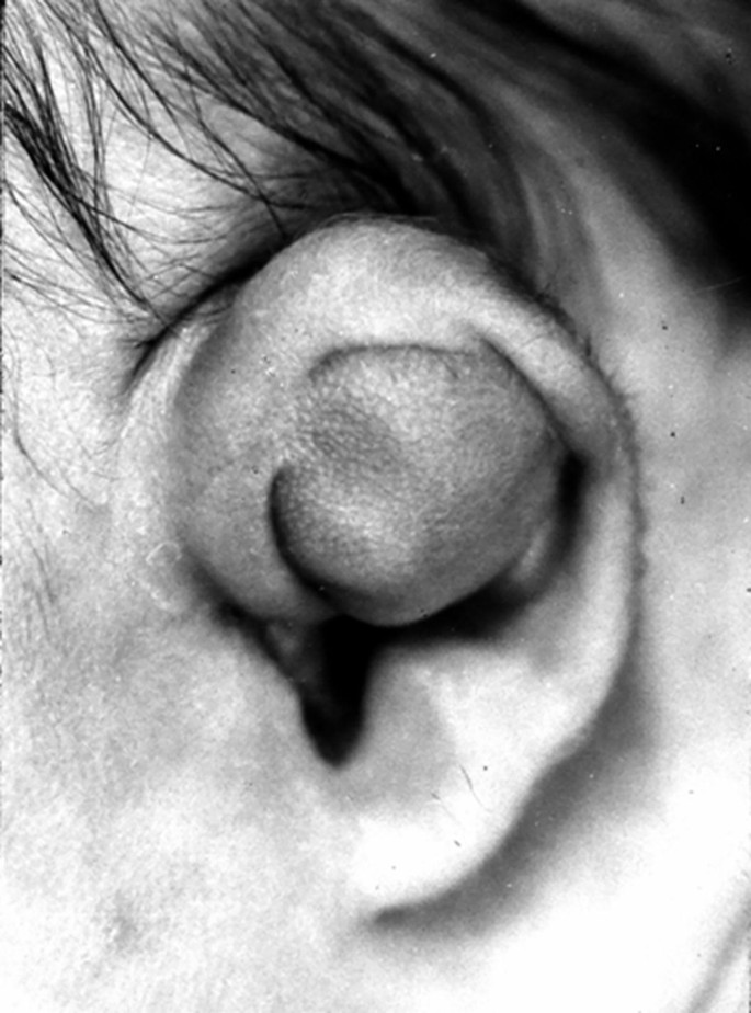 A clinical image of an ear cyst located on the anti-helix. The cyst is swollen such that it covers the concha.