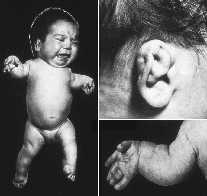 A set of 3 clinical images. The left image is of a neonate affected by diastrophic dwarfism. The top right image is of the ear cyst. The bottom right image is of the neonate's hand exhibiting deformities.