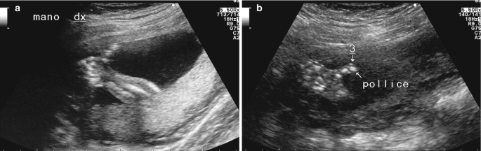 A set of 2 ultrasonograms of a 17-week-old fetus. A represents a hitchhiker's thumb. B comprises an arrow pointing in the center to discrete regions of hyperintensity labeled pollice.
