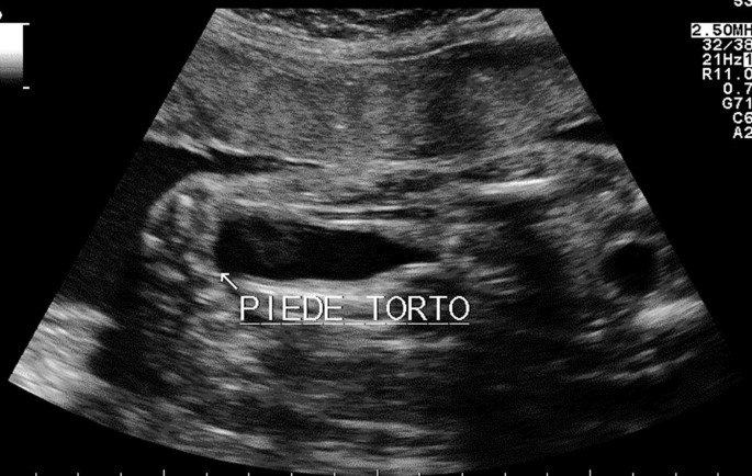 An ultrasonogram of a fetus exhibiting piede torto, indicated by an arrow on the dark patches.