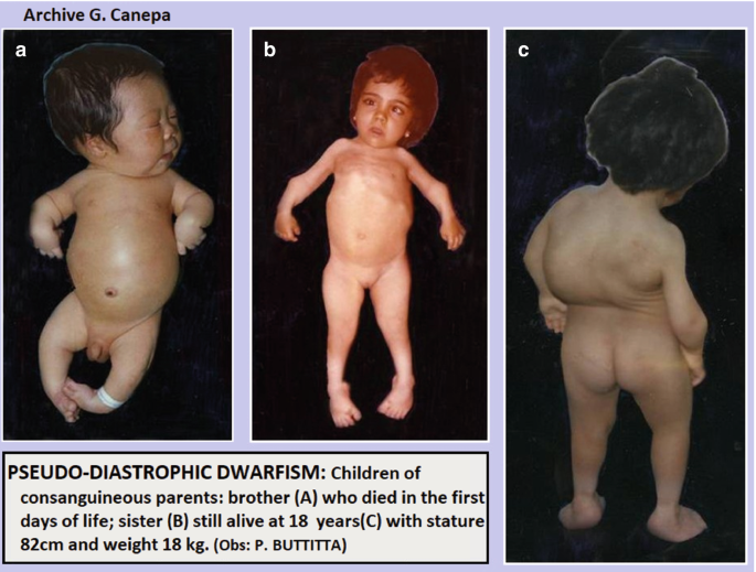 A set of 3 clinical images, a to c, of children born to consanguineous parents. A is an image of an infant boy with a narrow chest and rhizomelic dwarfism. B and C are ventral and dorsal images of a girl at 18 exhibiting scoliosis, rhizomelic dwarfism, hitchhiker's thumb, and joint stiffness.
