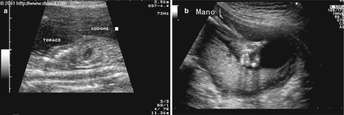 A set of 2 ultrasonographs, a and b, of a fetus in the womb. A represents the narrow chest size of the fetus. B represents the hitchhiker's thumb condition.