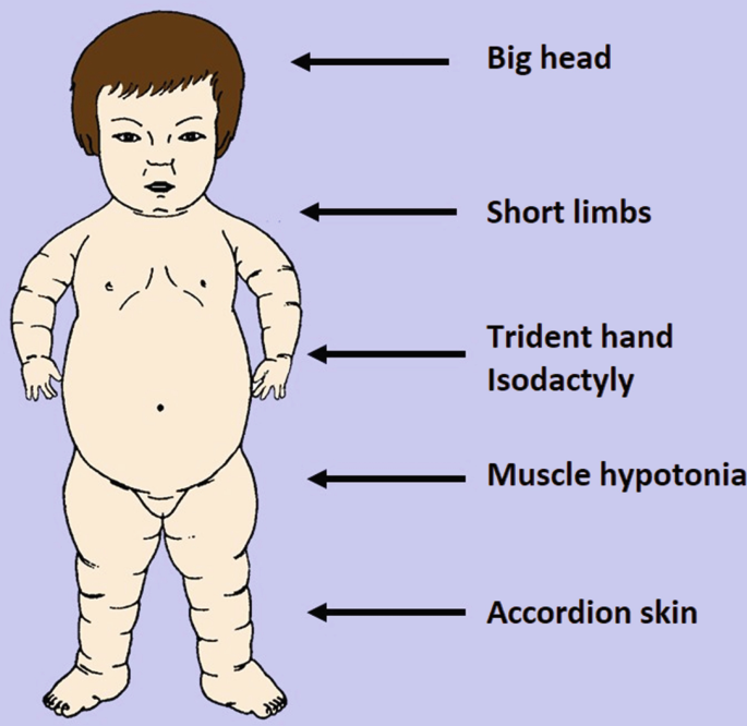 An illustration of a case of achondroplasia. The labeled characteristics are a big head, short limbs, a trident hand with isodactyly, muscle hypotonia, and accordion skin.