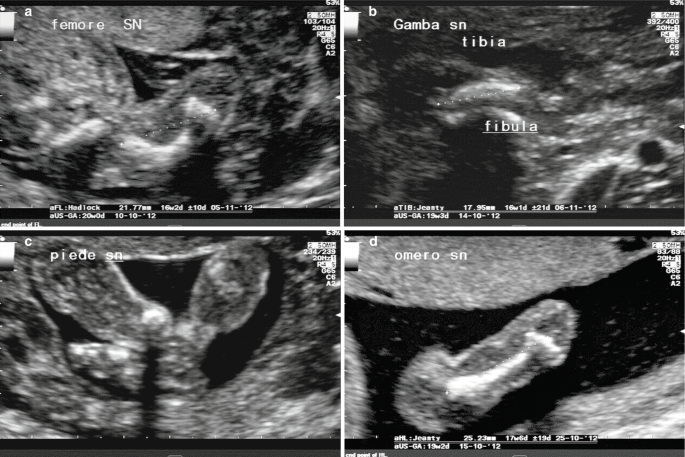 A set of 4 ultrasonographs, a to d, of a 21-weeks-old fetus in the womb. A represents a curved femur. B represents a deformed tibia and fibula. C represents soft-tissue exuberance. D indicates the club-shaped humerus.