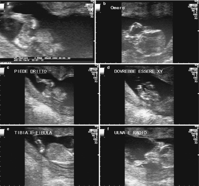 A set of 6 ultrasonographs of a fetus affected by kyphomelic dysplasia. The scans identify different deformities in the fetus as hyperintense structures, such as abnormally curved bones. The genitals are identified as male.