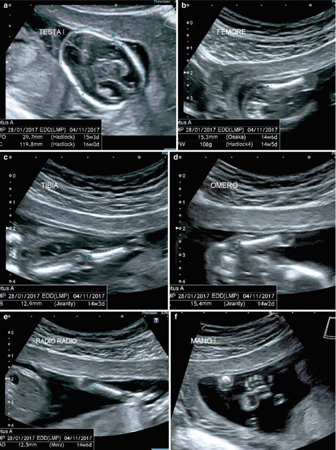 A set of 6 ultrasonographs, a to f, of a 17-week-old fetus. The scans identify dolichocephaly, brachydactyly, underdeveloped long bones of the lower limbs, and clinodactyly of the fifth finger.