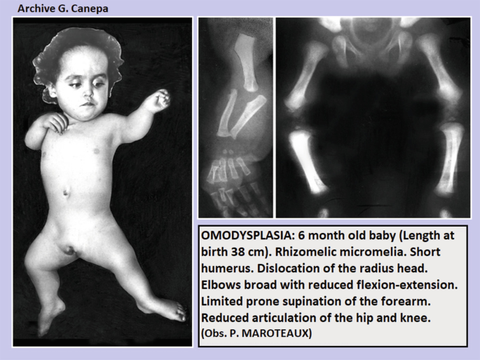 A set of 3 clinical images. The left image is of a 6-month-old baby measuring 38 centimeters in length. The middle scan is a radiograph of the hand bones of the baby. The right scan is a radiograph of the lower limbs of the baby. The Rhizomelic micromelia is prominent.