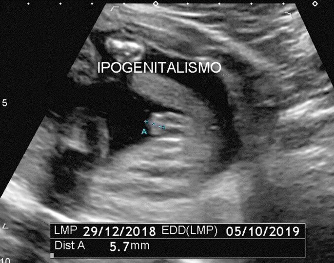 An ultrasonogram of a fetus in the mother's womb. The genitals are identified as male and underdeveloped.