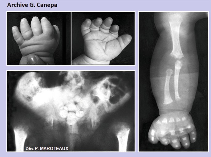 A set of 4 clinical images. The top left and top middle images are of the hands of a baby with stubby digits. The bottom left image is a radiograph of the pelvis with high degrees of calcification. The right scan is a radiograph of an arm with an underdeveloped radius of the ulna and short digits.