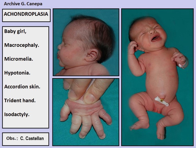 A set of 3 clinical images indicates achondroplasia in an infant girl. The top left image represents macrocephaly. The bottom left image is of the hand indicating accordion skin, trident hand, and isodactyly. The right image is of the full body of the infant with micromelia and hypotonia.