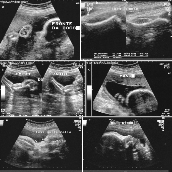 A set of 10 ultrasonographs of a 34-week fetus captured at 19 to 30 Hertz. The scans represent the fetus exhibiting achondroplasia characteristics such as a prominent forehead, abnormally developed nasal structure, and fusion of 2 fingers.
