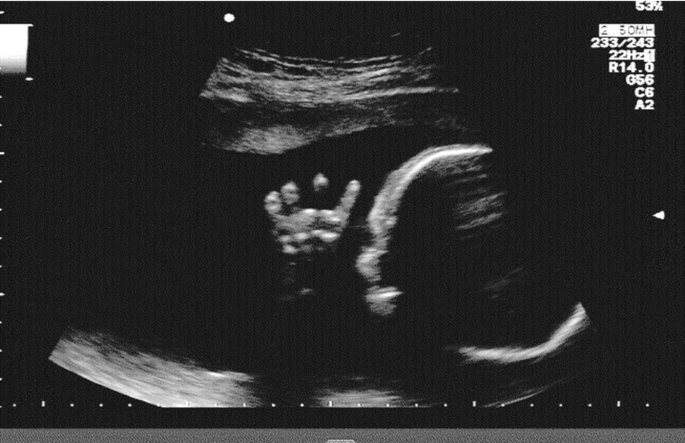 An ultrasound scan presents a newborn with hypochondroplasia. The digits on the hand are short and abnormally curved.