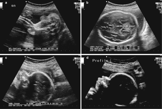 A set of 4 ultrasonographs, a to d, of a 25-week fetus. A represents an underdeveloped fetus. B indicates a slightly enlarged head. C represents normal nasal development. D represents swelling of the glabella and an enlarged head.