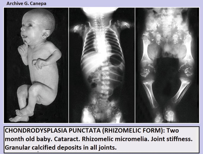 A set of 3 clinical images. The left image is of a 2-month-old infant affected by chondrodysplasia punctata. The middle image is an ultrasonograph of the chest and abdomen, representing a cataract and stiff and calcified joints. The right scan represents granular calcium deposits in the lower limbs.