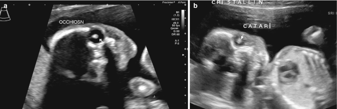 A set of 2 ultrasonograms of a fetus. In a, an arrow points to a hyperintense occhiosn. In b, an arrow points to a blurry catar.