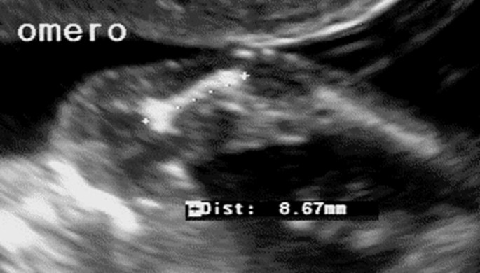 An ultrasonogram of a 15-week-old fetus represents a hyperintense structure labeled omero identified at 8.67 millimeters distance.