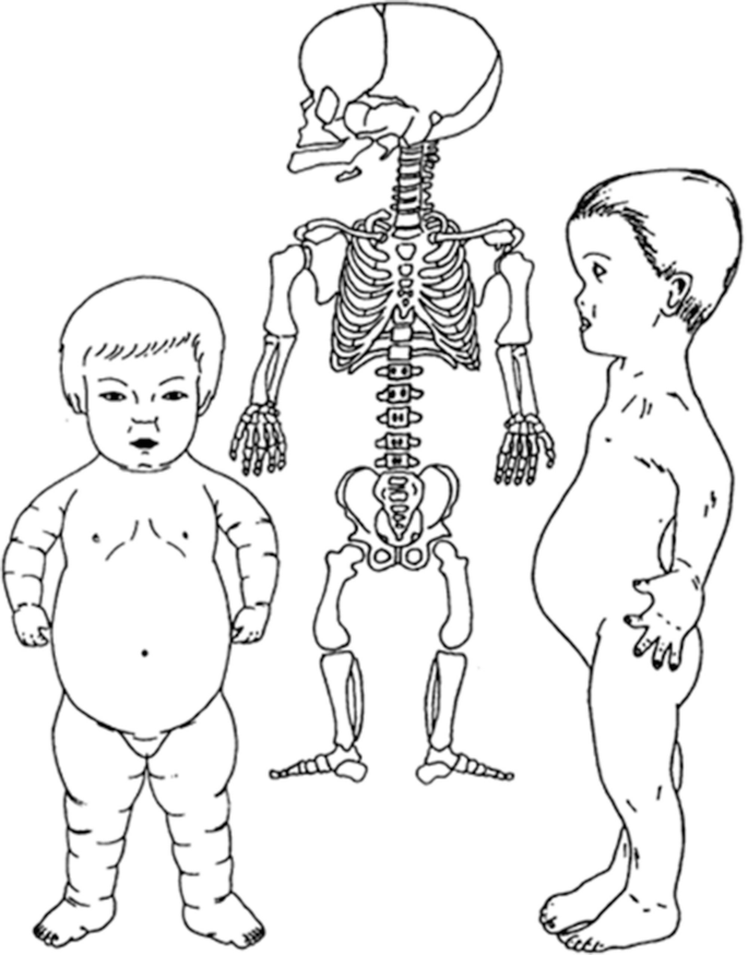 A 3-part illustration comprising 2 dwarfs and 1 dwarf skeleton with achondroplasial growth.