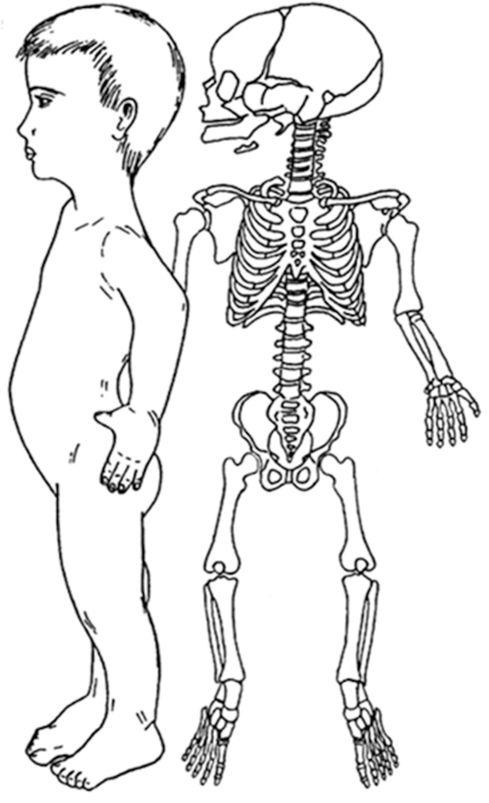 A 2-part illustration. The left part illustrates the side profile of a person affected by hypochondroplasia. The right part illustrates the hypochondroplasia-affected skeleton.