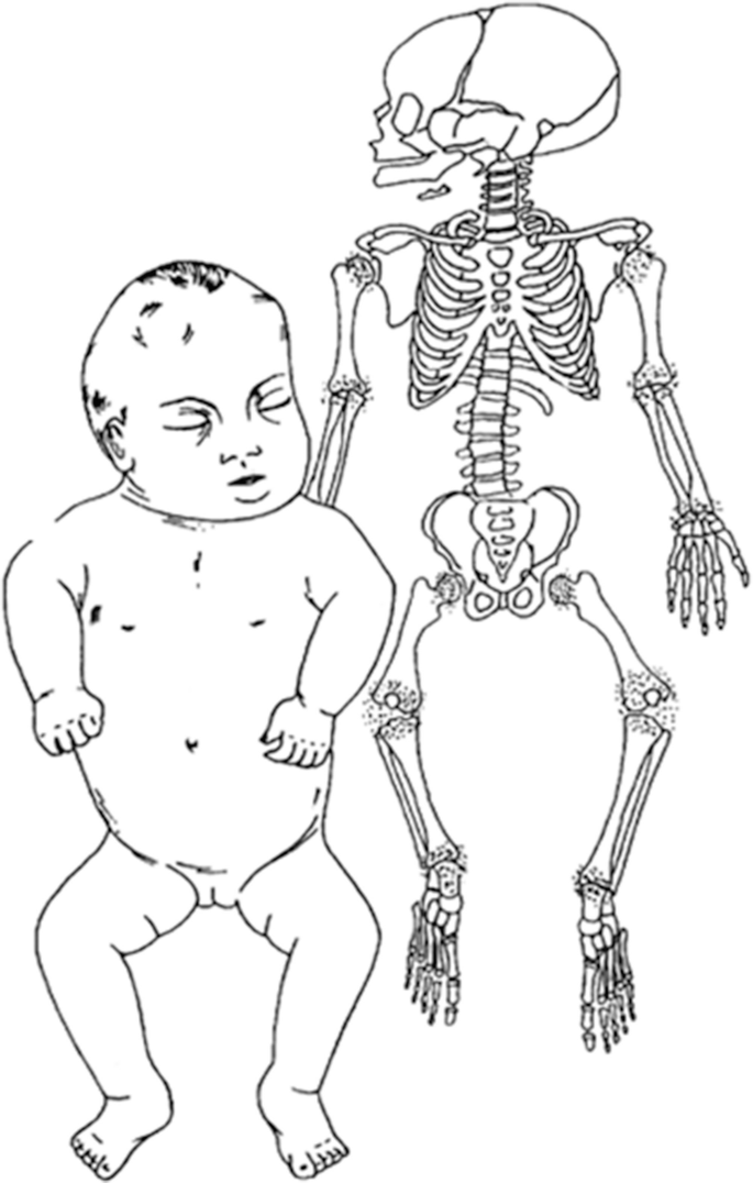 A 2-part illustration. The left part illustrates the form of a case of chondrodysplasia punctata, and the right part illustrates the skeletal appearance.