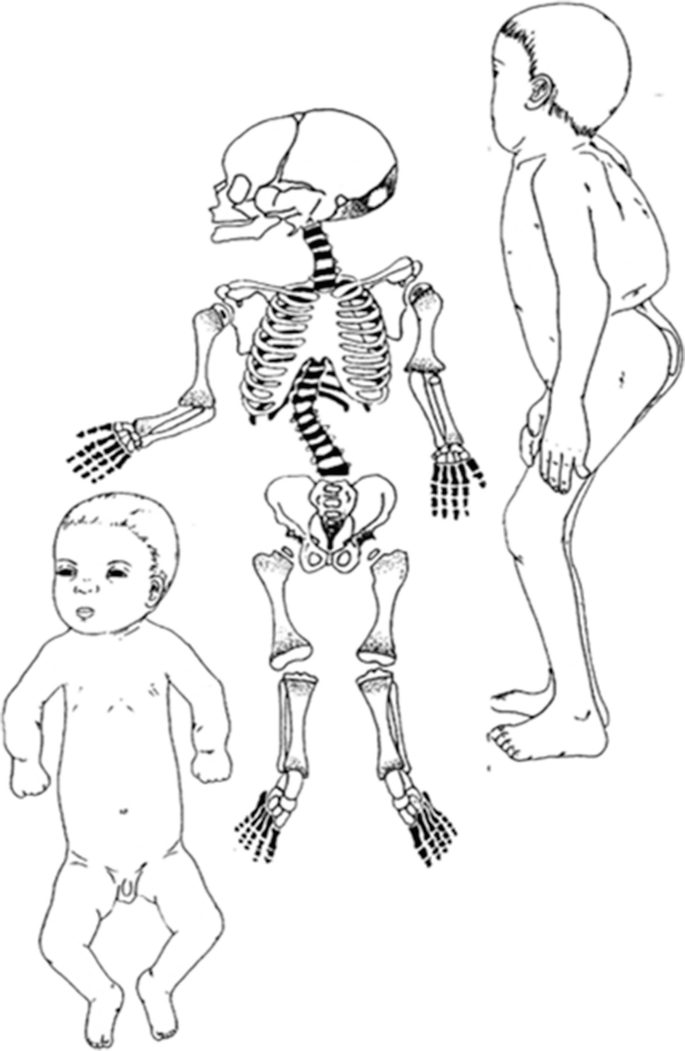 A 3-part illustration. The left and right illustrations represent a case of metatropic dysplasia in front and side views. The middle illustration is a skeletal representation of the condition.