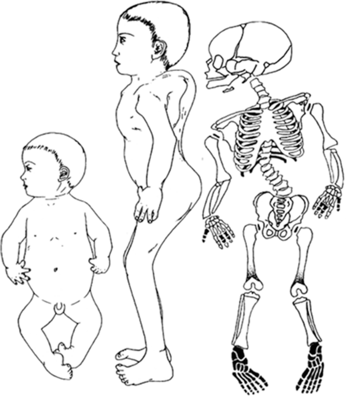 A 3-part illustration. The left and middle illustrations represent an infant and a grown-up case of diastropic dwarfism in lateral views, respectively. The right illustration is of the skeletal changes following the condition.