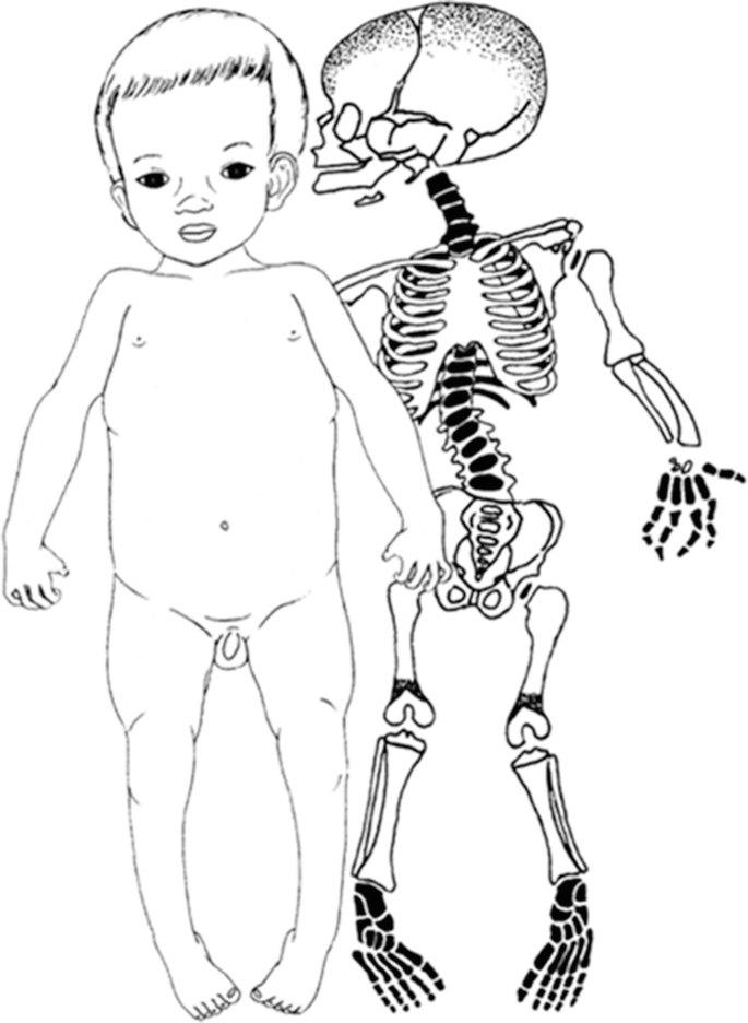 A 2-part illustration. The left part is the morphological appearance a case of pseudodiastrophic dysplasia. The right part is the skeletal appearance of the case.