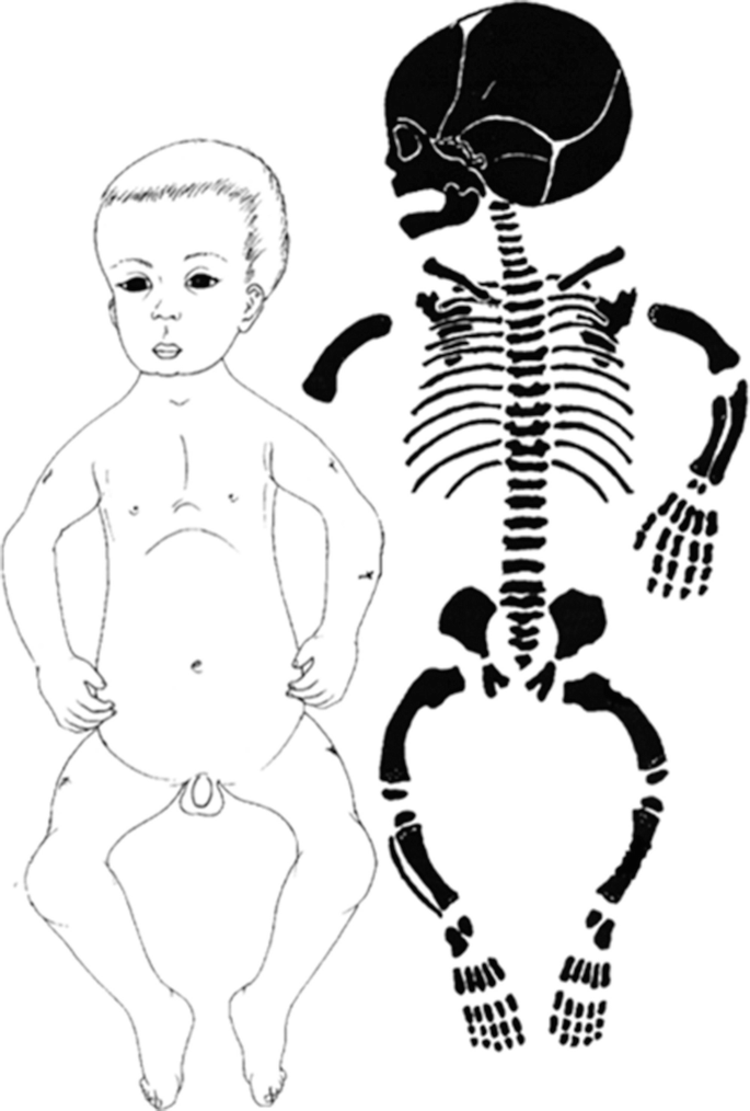 A 2-part illustration. The left part illustrates the morphology of a case of kyphomelic dysplasia. The right part illustrates the skeletal appearance of the disorder.