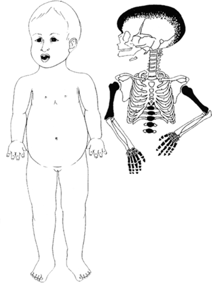 A 2-part illustration. The left part illustrates the morphological features in cranioectodermal dysplasia. The right part illustrates the skeletal form of the condition.