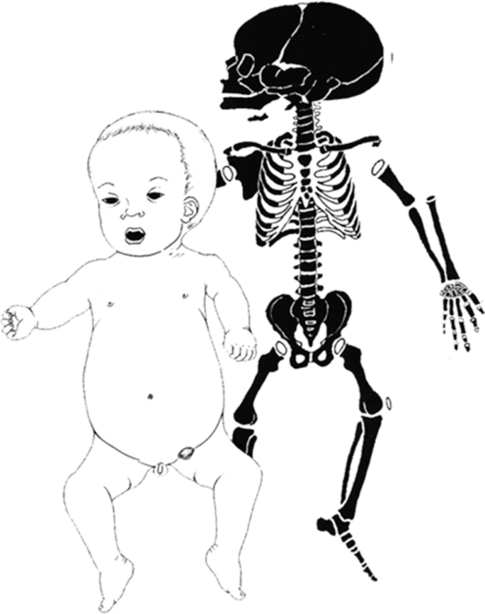 A 2-part illustration. The left part illustrates the morphology of omodysplasia. The right part illustrates the skeletal appearance.